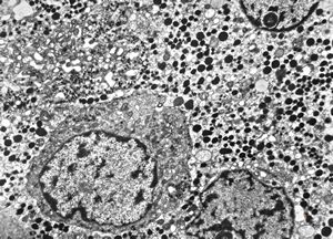 M, 23y. | acidophilic pituitary adenoma (STH) M, 23y. | acidophilic pituitary adenoma (STH)